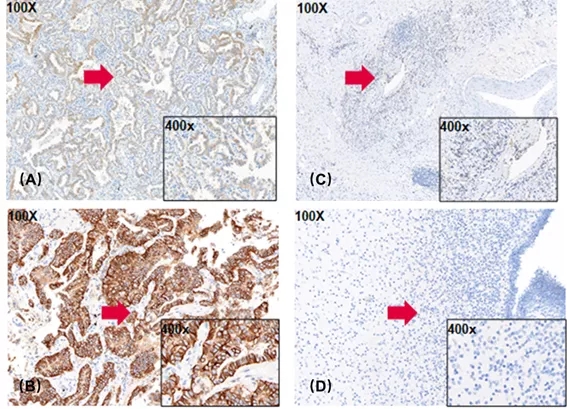 肿瘤患者组织IHC染色结果.webp